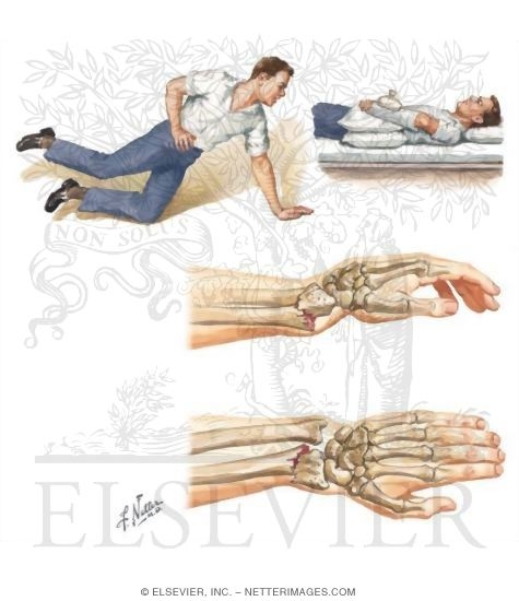 Colles' (Distal Radial) Fracture