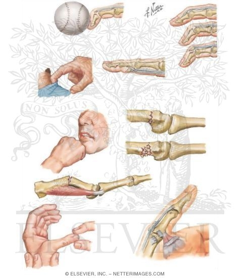 Finger Injuries