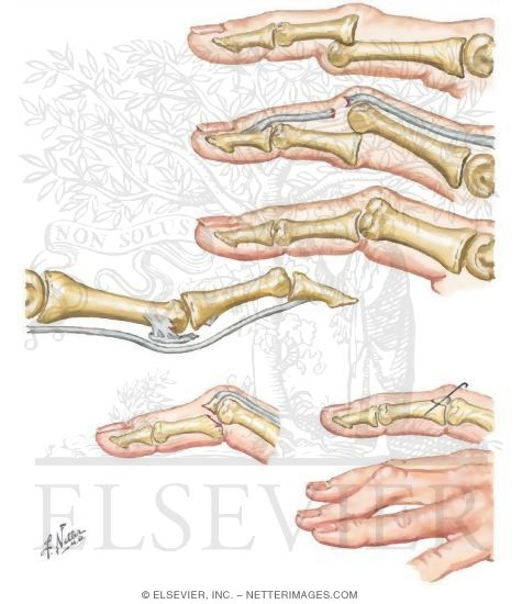 Proximal Interphalangeal Joint Dislocations