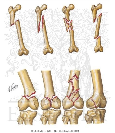 Watermarked preview of unlabeled image: Fractures of the Shaft and Distal Femur