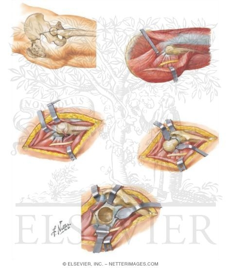 Watermarked preview of unlabeled image: Surgical Approach to Total Hip Replacement
