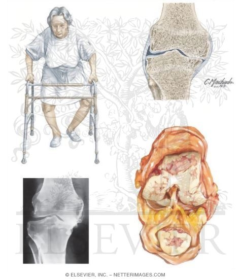 Watermarked preview of unlabeled image: Osteoarthritis of the Knee