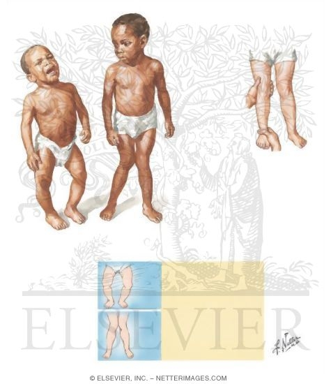 Genu Varum and Falgum
Bowleg and Knock-Knee