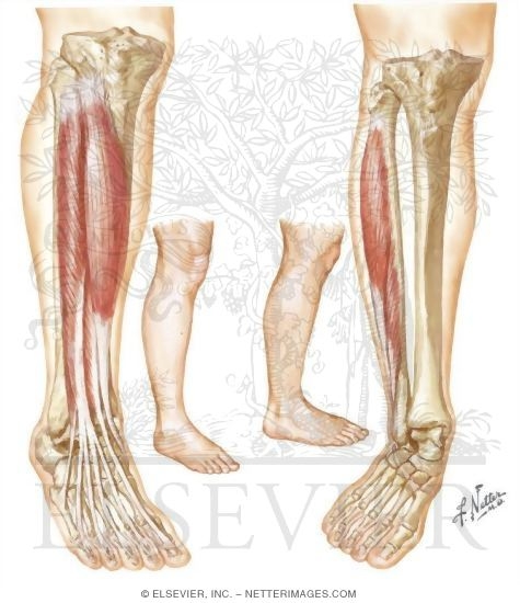 Watermarked preview of unlabeled image: Exertional Compartment Syndromes