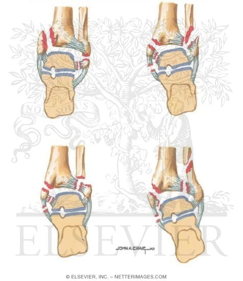 Watermarked preview of unlabeled image: Classification of Ankle Fractures
