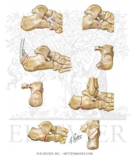 Watermarked preview of unlabeled image: Fractures of the Calcaneus