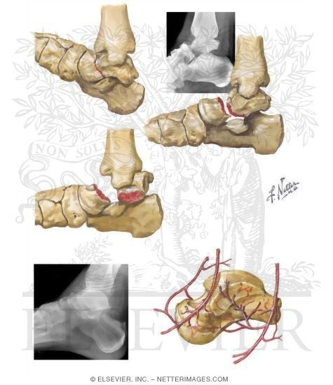 Fractures of the Talar Neck
