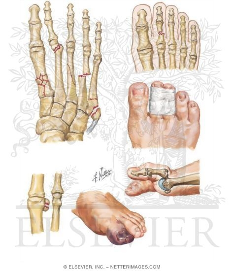 Metatarsal and Phalangeal Injuries