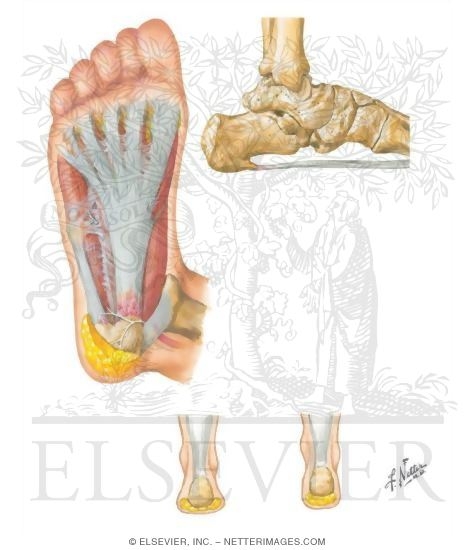 Watermarked preview of unlabeled image: Plantar Fasciitis