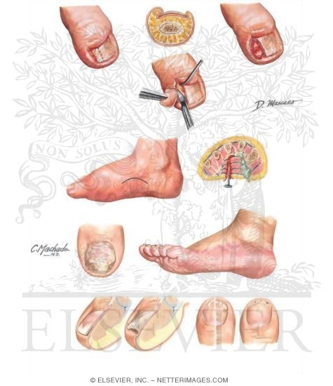 Common Foot Infections