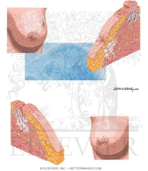 Clinical Signs of Breast Cancer