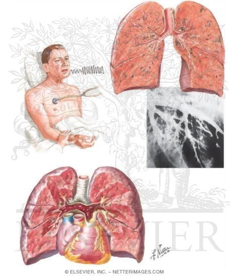 Watermarked preview of unlabeled image: Pulmonary Embolism