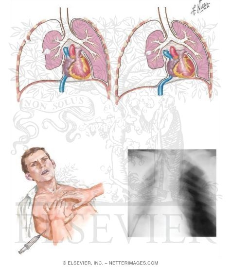 Tension Pneumothorax