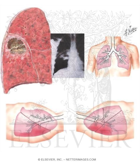 Watermarked preview of unlabeled image: Lung Abscess