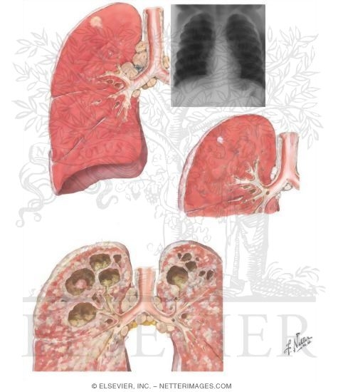 Pulmonary Tuberculosis
