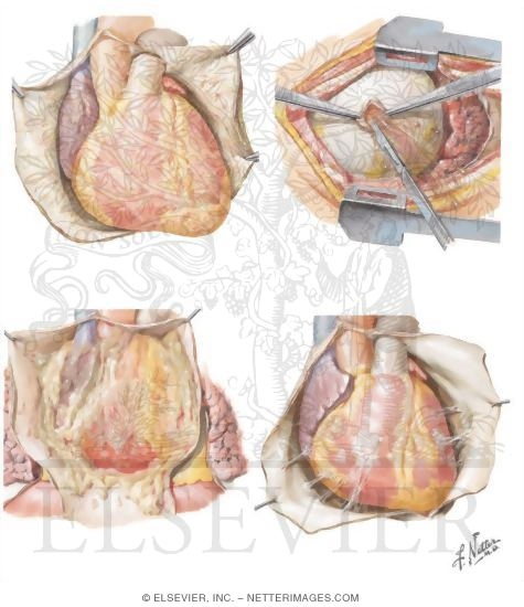 Pericarditis
