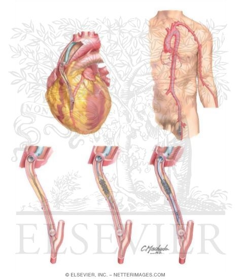 Saphenous Vein Graft Disease