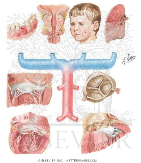 Infective Endocarditis