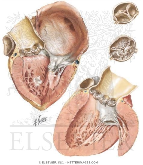 Watermarked preview of unlabeled image: Valvular Heart Disease