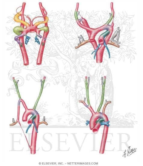 Embryology: Aortic Arches