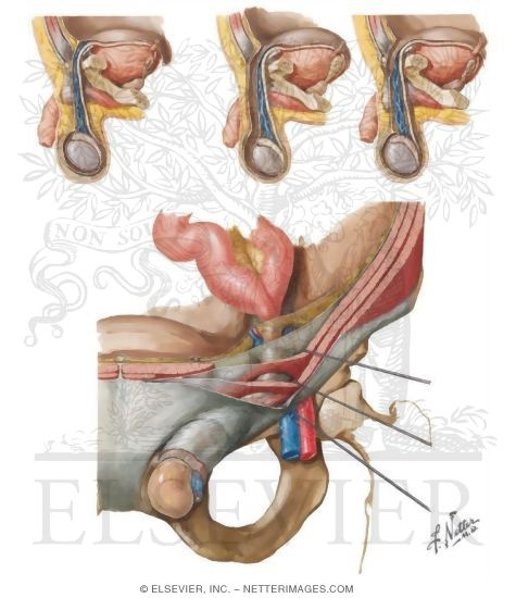 Abdominal Wall: Inguinal Hernia