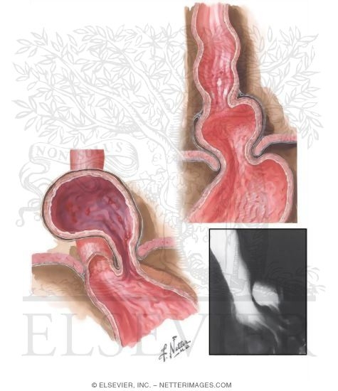 Hiatal Hernia