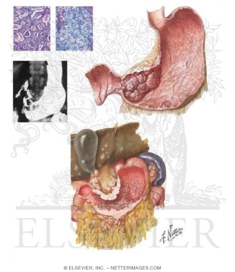 Watermarked preview of unlabeled image: Gastric Carcinoma