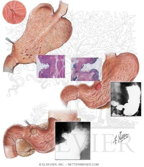 Watermarked preview of unlabeled image: Peptic Ulcer Disease