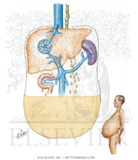 Watermarked preview of unlabeled image: Ascites