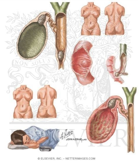 Cholelithiasis (Gallstones)