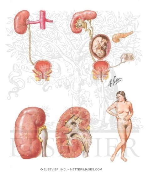 Pyelonephritis and constipation image