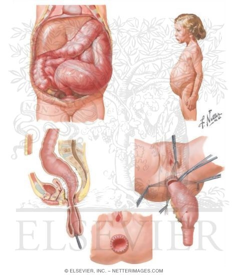 Congenital Megacolon (Hirschsprung's Disease)