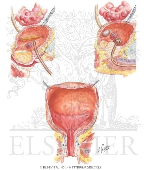 Watermarked preview of unlabeled image: Urinary Tract Infections: Cystitis