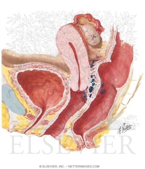 Watermarked preview of unlabeled image: Endometriosis