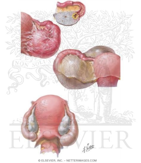 Watermarked preview of unlabeled image: Chronic Pelvic Inflammatory Disease