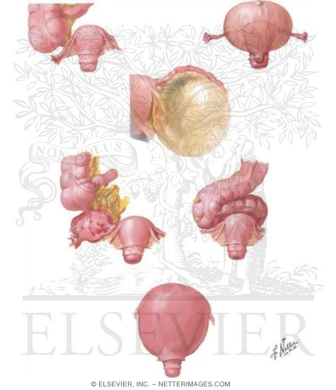 Ovarian Cysts