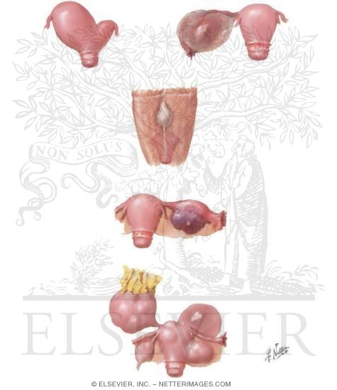 Watermarked preview of unlabeled image: Ovarian Tumors