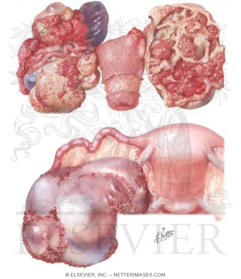 Watermarked preview of unlabeled image: Ovarian Tumors