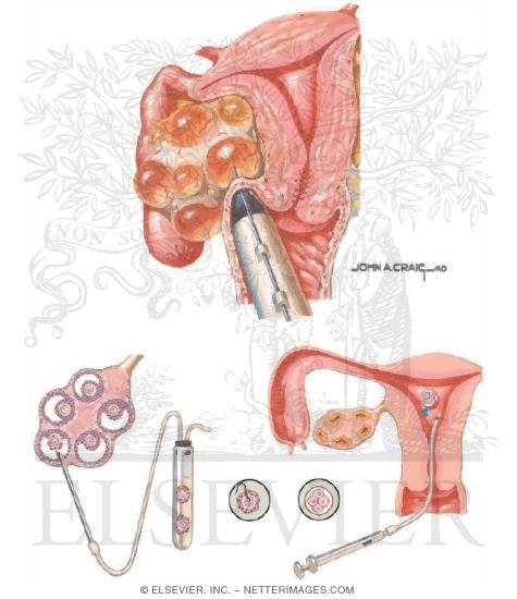 Watermarked preview of unlabeled image: Assisted Reproduction