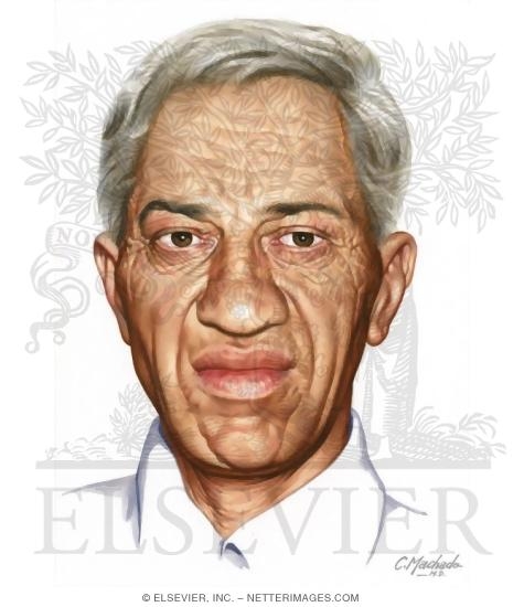 Watermarked preview of unlabeled image: Acromegaly