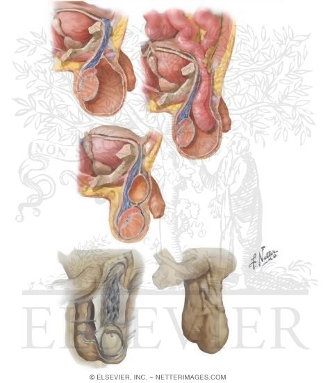 Watermarked preview of unlabeled image: Hydrocele and Varicocele