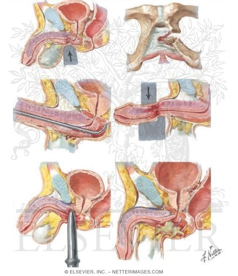 Urethral Trauma In the Male
