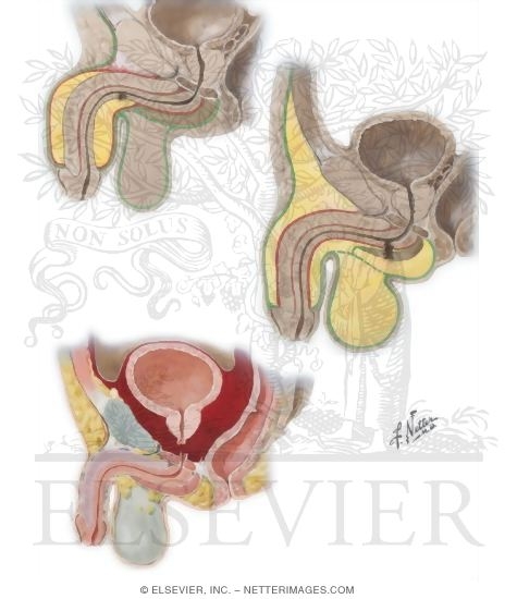 Urine Extravasation
