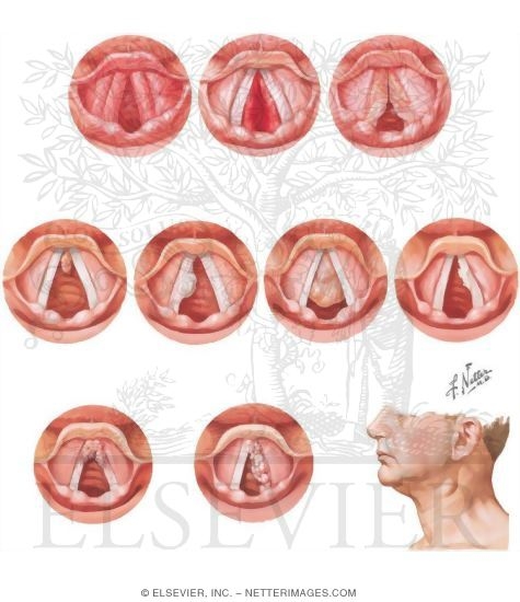 Hoarseness