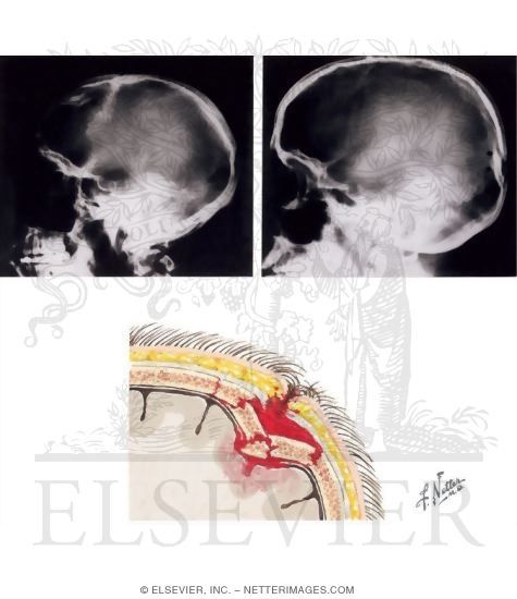 Compound Depressed Skull Fractures