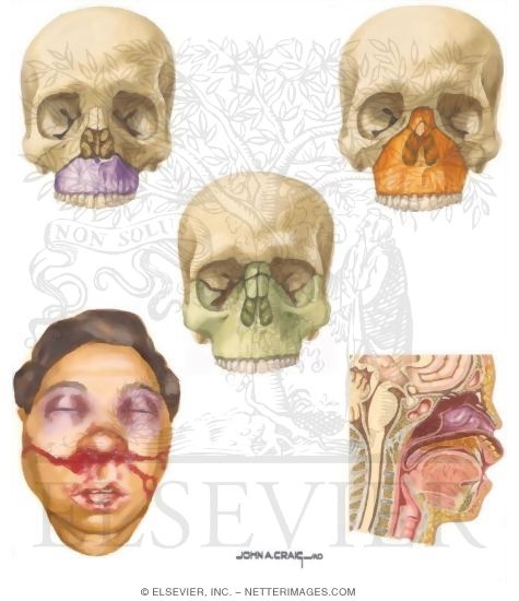 Midface Fractures