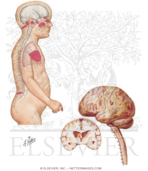 Watermarked preview of unlabeled image: Meningitis