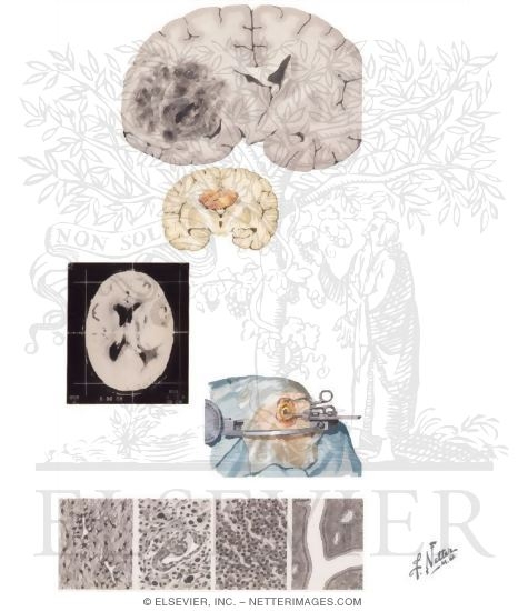 Watermarked preview of unlabeled image: Gliomas