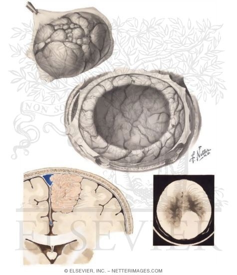 Watermarked preview of unlabeled image: Meningiomas