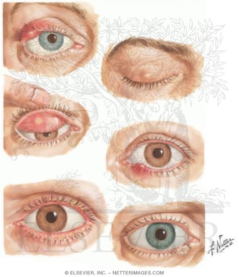 Eyelid Infection and Conjunctival Disorders